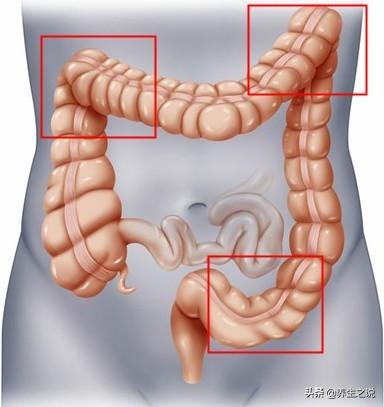 「大便」出现这种徵兆,最好去检查一下,肠道可能「癌变」了!